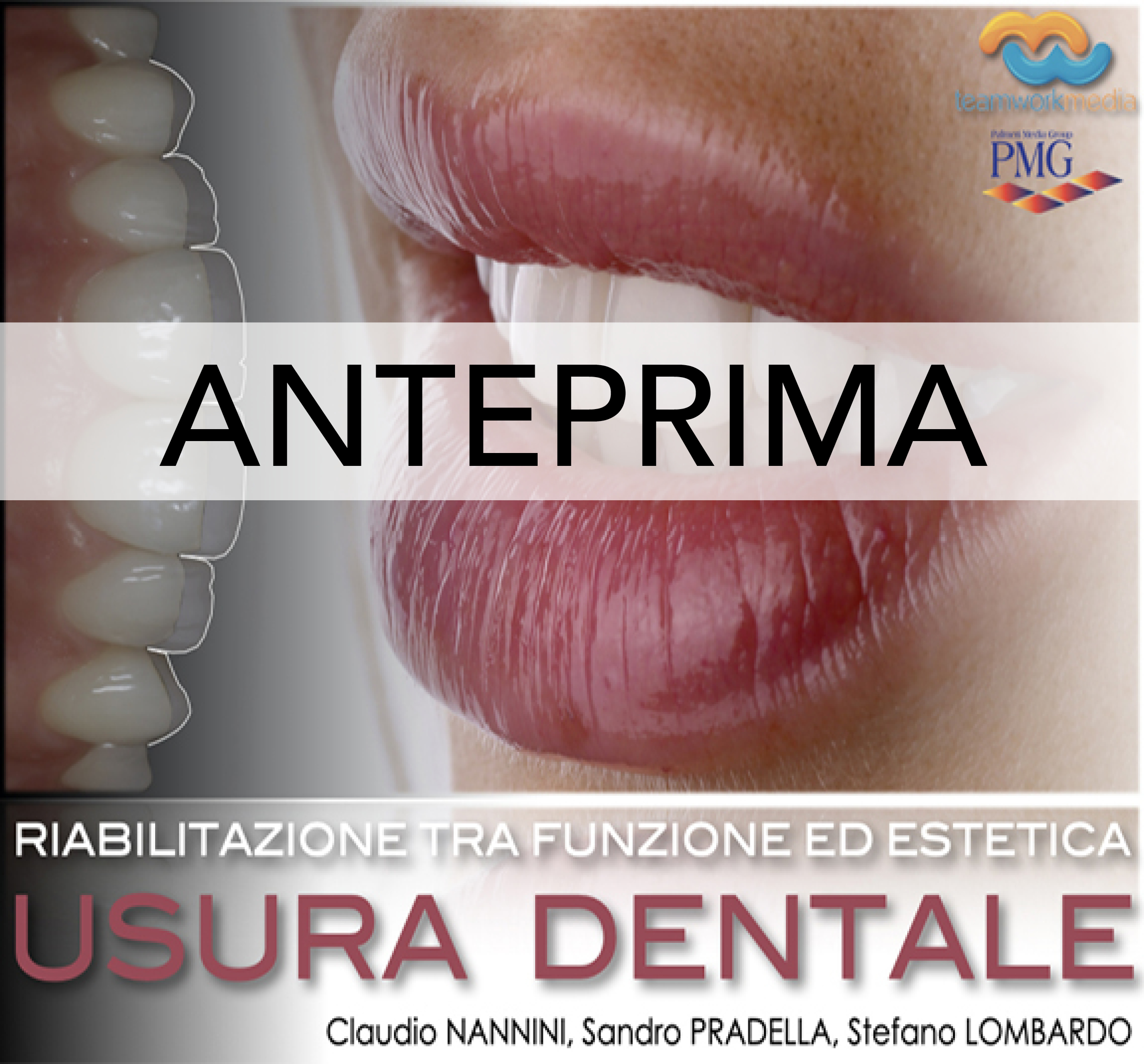 RIABILITAZIONE TRA FUNZIONE ED ESTETICA. USURA DENTALE