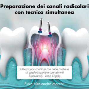 Preparazione dei canali radicolari con tecnica simultanea
