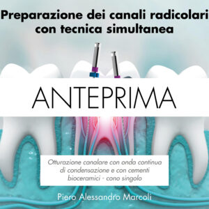 Preparazione dei canali radicolari con tecnica simultanea