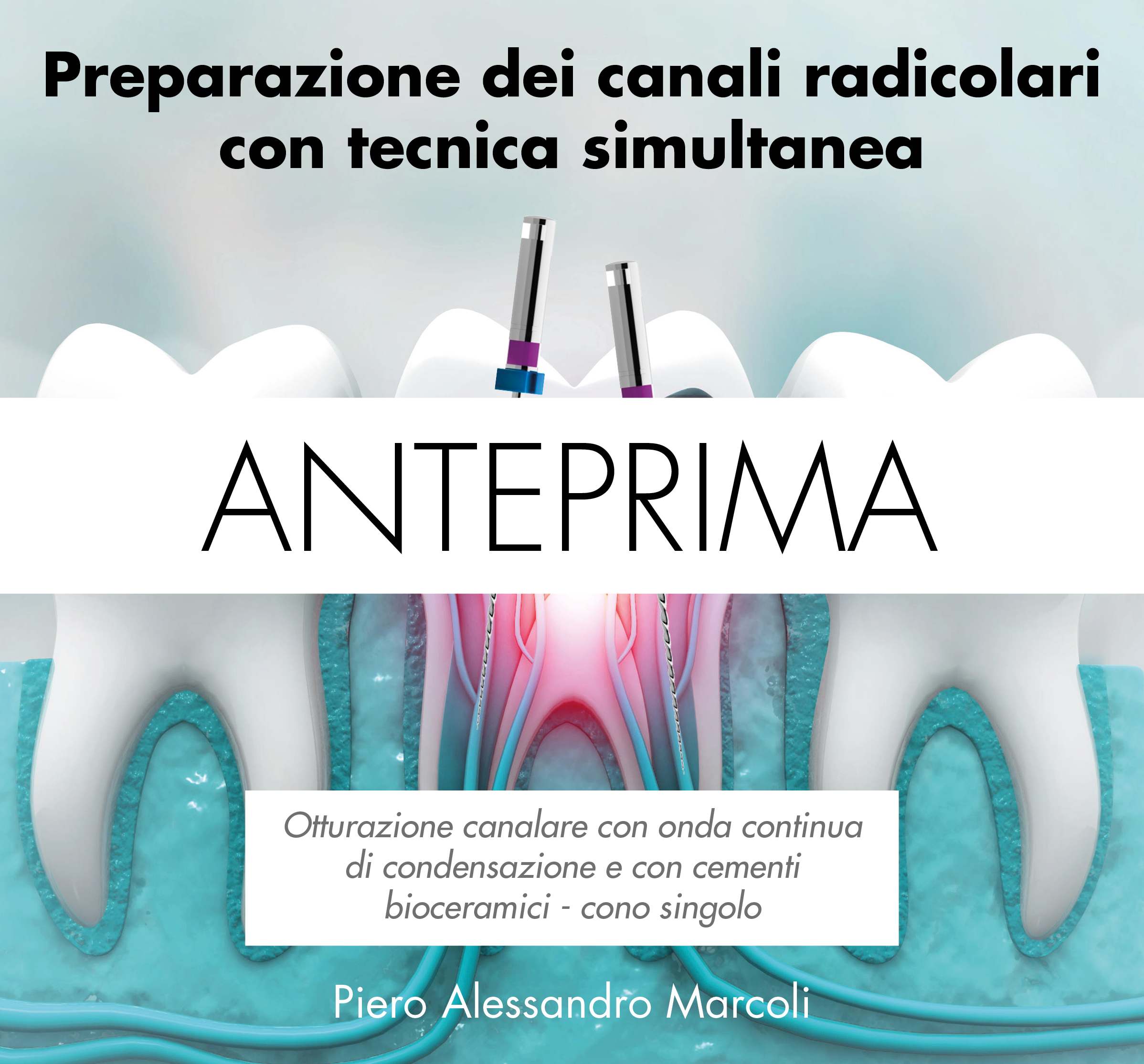 Preparazione dei canali radicolari con tecnica simultanea